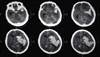 Predicting Major Bleeding in Patients With Stroke on Antiplatelet Agents Predicting Major Bleeding in Patients With Stroke on Antiplatelet Agents