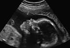 Another Case of Zika-Related Microcephaly Reported in the US Another Case of Zika-Related Microcephaly Reported in the US