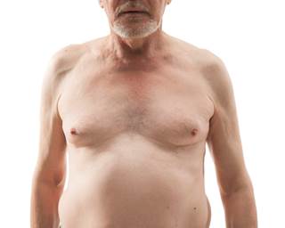 Obesity, Physical Activity Level May Influence Brain Tumor Risk Obesity, Physical Activity Level May Influence Brain Tumor Risk