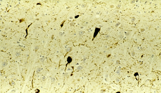 The researchers found that 29.3% of participants exhibited high Aβ burden. The researchers found that 29.3% of participants exhibited high Aβ burden.