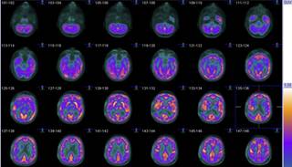 Epilepsy and Migraine: A Common Ground? Epilepsy and Migraine: A Common Ground?