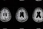 Cervical Cord Atrophy, Lesions Predict Disability in Multiple Sclerosis Cervical Cord Atrophy, Lesions Predict Disability in Multiple Sclerosis