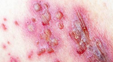Shingrix Recommended First-Line Vaccination for Herpes Zoster Shingrix Recommended First-Line Vaccination for Herpes Zoster