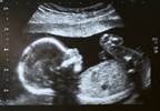 Prenatal Exposure to SSRI Tied to Fetal Brain Development Prenatal Exposure to SSRI Tied to Fetal Brain Development