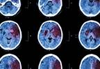 MRI May Help Determine IV tPA Eligibility in Stroke of Unknown Onset MRI May Help Determine IV tPA Eligibility in Stroke of Unknown Onset