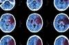 Stroke Risk After Cardiac Surgery Stroke Risk After Cardiac Surgery