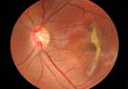 Levodopa May Protect Against Age-Related Macular Degeneration Levodopa May Protect Against Age-Related Macular Degeneration