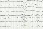 Identifying Pediatric Seizures With Hemispheric Regional Cerebral Oxygen Saturation Identifying Pediatric Seizures With Hemispheric Regional Cerebral Oxygen Saturation