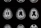 Ocrelizumab Reduces Disease Activity in Primary Progressive MS Ocrelizumab Reduces Disease Activity in Primary Progressive MS