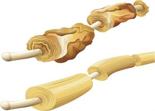 Cladribine is not currently approved by the FDA for the treatment of multiple sclerosis. Cladribine is not currently approved by the FDA for the treatment of multiple sclerosis.