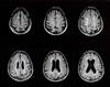 Case Report: Focus on CNS Pathology May Benefit Rescue From Rebound MS Case Report: Focus on CNS Pathology May Benefit Rescue From Rebound MS