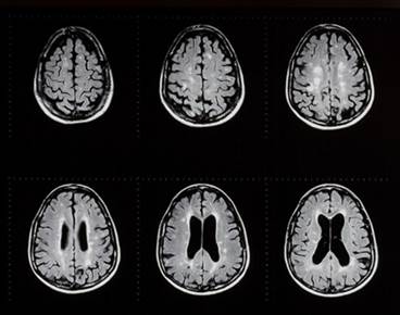 McDonald Criteria Update: Further Distinction Between Relapsing-Remitting, Primary-Progressive MS McDonald Criteria Update: Further Distinction Between Relapsing-Remitting, Primary-Progressive MS