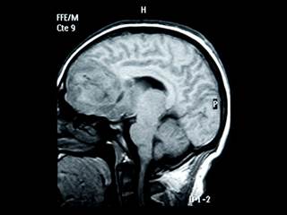 The authors examined measurements of cortical thickness and intracortical magnetization transfer (MT), a validated MRI marker for myelination, over time with regards to genomic patterning. The authors examined measurements of cortical thickness and intracortical magnetization transfer (MT), a validated MRI marker for myelination, over time with regards to genomic patterning.