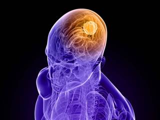 Electromagnetic Field Therapy Promising for Glioblastoma Treatment Electromagnetic Field Therapy Promising for Glioblastoma Treatment