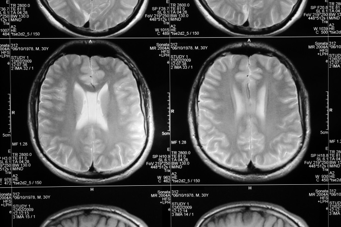 Pediatric Depression Linked to Loss of Grey Matter