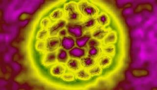 There was no association between receiving steroids prophylactically versus therapeutically and IRIS latency or duration. There was no association between receiving steroids prophylactically versus therapeutically and IRIS latency or duration.