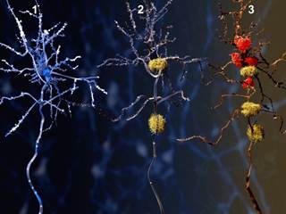 OSA may put individuals at greater risk for Alzheimer's disease. OSA may put individuals at greater risk for Alzheimer's disease.