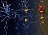 Primary Progressive Aphasia Pathology May Help Differentiate Dementia Subtypes Primary Progressive Aphasia Pathology May Help Differentiate Dementia Subtypes