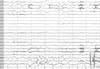 Case Study: Surgical Tx of Refractory Seizures in a Child with Hx of AVM, ICH Case Study: Surgical Tx of Refractory Seizures in a Child with Hx of AVM, ICH