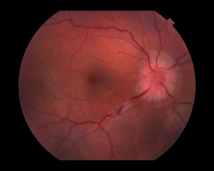 neuro-ophthalmology-types-conditions-oomc