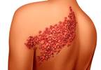 Treating Shingles Does Not Reduce Increased Risk for Stroke Treating Shingles Does Not Reduce Increased Risk for Stroke