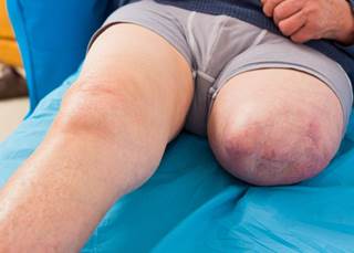 Promising Treatment for Phantom Limb Pain in Amputees Promising Treatment for Phantom Limb Pain in Amputees