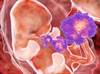 Early Infection With Zika Virus Associated With More Birth Defects in Pregnancy Early Infection With Zika Virus Associated With More Birth Defects in Pregnancy