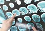 Misdiagnosis of MS Common, Associated With Morbidity Misdiagnosis of MS Common, Associated With Morbidity