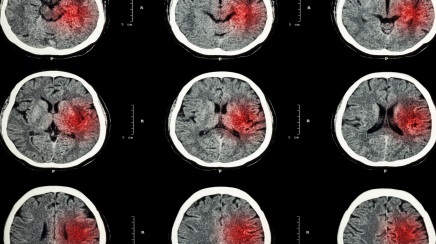 Blood Pressure Management Is Only Part Of The Story In Intracerebral ...