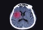 Risk Factors for Dementia Vary After Intracerebral Hemorrhage Risk Factors for Dementia Vary After Intracerebral Hemorrhage