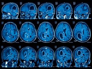In Glioblastoma, Personalized Medicine is a Challenge In Glioblastoma, Personalized Medicine is a Challenge
