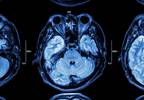 Cortical Molecular Markers Differentiate Psychotic, Bipolar Disorders Cortical Molecular Markers Differentiate Psychotic, Bipolar Disorders