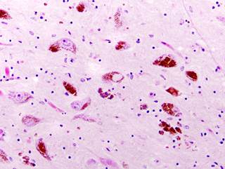 Patients with mild cognitive impairment with preserved hippocampal volume are at increased risk for dementia with Lewy bodies vs Alzheimer disease. Patients with mild cognitive impairment with preserved hippocampal volume are at increased risk for dementia with Lewy bodies vs Alzheimer disease.