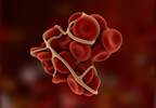 Unprovoked Venous Thromboembolism May Be Sign of Occult Cancer Unprovoked Venous Thromboembolism May Be Sign of Occult Cancer