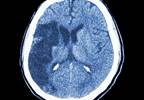 Migraine-Associated Stroke Not Linked to Atherosclerosis Migraine-Associated Stroke Not Linked to Atherosclerosis