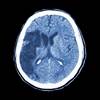 Pregnancy-Associated Stroke in Women With Preeclampsia Pregnancy-Associated Stroke in Women With Preeclampsia