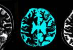 Hep C Compounds Alcoholism's Effect on Brain Volume Hep C Compounds Alcoholism's Effect on Brain Volume