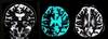 Focal Brain Atrophy Predicts Cognitive Decline in Parkinson Disease After DBS Focal Brain Atrophy Predicts Cognitive Decline in Parkinson Disease After DBS