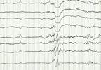 Spike Localization May Predict Cognitive Outcomes in BECTS Spike Localization May Predict Cognitive Outcomes in BECTS