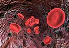 After Stroke, Intensive Antiplatelet Therapy Has Benefits, Drawbacks After Stroke, Intensive Antiplatelet Therapy Has Benefits, Drawbacks