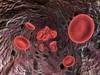 Obstructive Sleep Apnea Severity Not Associated With Hematocrit Level, Erythrocytosis Obstructive Sleep Apnea Severity Not Associated With Hematocrit Level, Erythrocytosis