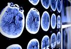 CHD, Stroke Risk Markedly Increased in Diabetics With Both High TG, Low HDL-C CHD, Stroke Risk Markedly Increased in Diabetics With Both High TG, Low HDL-C