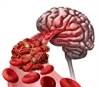 Shortening Reperfusion Times to Improve Poststroke Outcomes Shortening Reperfusion Times to Improve Poststroke Outcomes