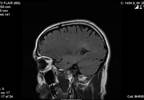 Concussion Tied to Increased Multiple Sclerosis Risk Concussion Tied to Increased Multiple Sclerosis Risk
