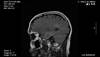 MS Mimics on MRI MS Mimics on MRI