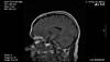 White Matter Hyperintensities Demonstrate Specific Spatiotemporal Evolution in Reversible Cerebral Vasoconstriction Syndrome White Matter Hyperintensities Demonstrate Specific Spatiotemporal Evolution in Reversible Cerebral Vasoconstriction Syndrome
