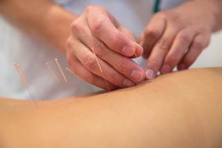 Acupuncture for Treatment of Chronic Pain Conditions Acupuncture for Treatment of Chronic Pain Conditions