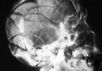 Sertraline Tx May Prevent Depression After Traumatic Brain Injury Sertraline Tx May Prevent Depression After Traumatic Brain Injury