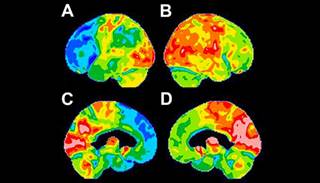 FDG-PET is a reliable tool for detecting consistent functional brain abnormalities in Parkinson disease when compared with other imaging modalities. FDG-PET is a reliable tool for detecting consistent functional brain abnormalities in Parkinson disease when compared with other imaging modalities.