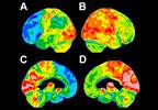 Atypical FDG-PET Patterns Predict Higher Dementia Risk in Parkinson Disease Atypical FDG-PET Patterns Predict Higher Dementia Risk in Parkinson Disease
